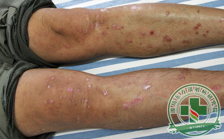 老年牛皮癣,牛皮癣怎么治疗,老年牛皮癣注意什么