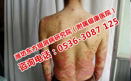 怎么能把银屑病治好呢
