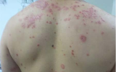 治疗银屑病的优势有哪些