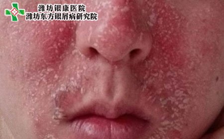 脸部牛皮癣症状,脸上牛皮癣什么表现