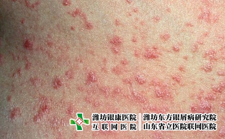 滴状银屑病2