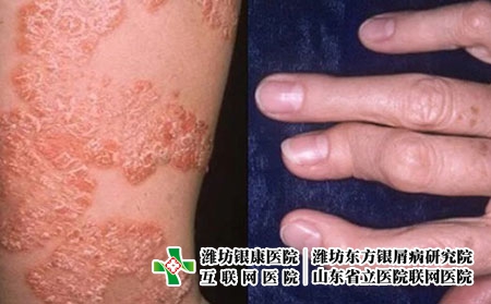 银屑病关节炎6 银屑病关节炎6