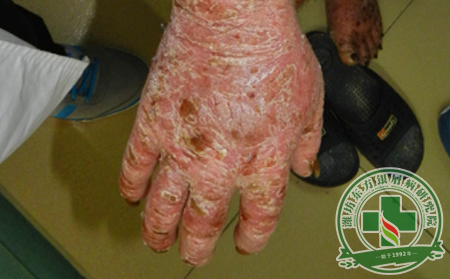 春季不感冒 儿童牛皮癣患者要多吃红果蔬