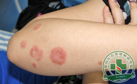 银屑病的症状特征是什么样?