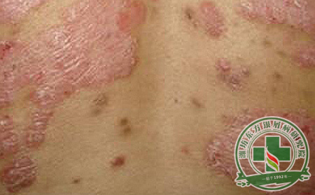 秋季银屑病患者如何控制鳞屑脱落