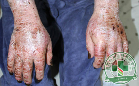 银屑病,脓疱型银屑病,症状