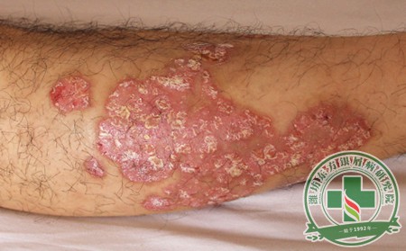 银屑病,脓疱型银屑病,症状