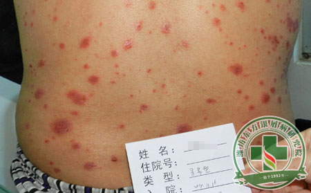 潍坊,银屑病,治疗