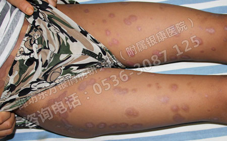 寻常型银屑病怎么治疗非常好