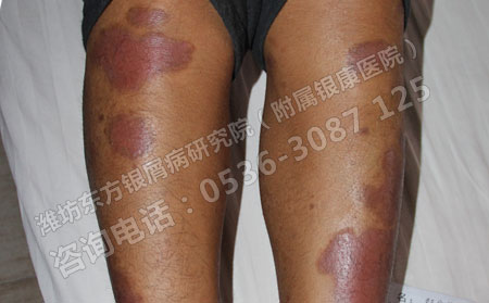 银屑病有哪些我们不知道的危害