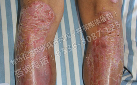 如何更有利于脓疱型银屑病的治疗
