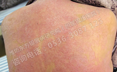 治疗寻常型屑病有什么可以方法