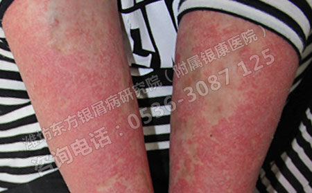 红皮型牛皮癣的诊断方法有哪些呢