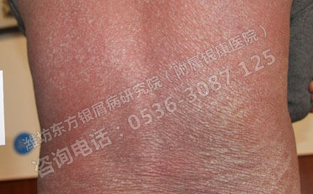 什么人比较容易患上银屑病呢