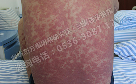 吃什么对银屑病的治好比较好呢