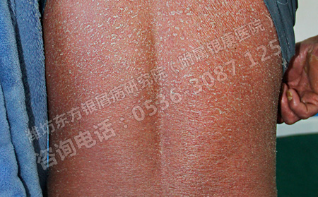 银屑病患者身体出现瘙痒怎么办