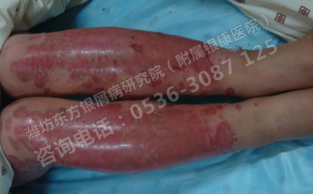 脸部银屑病要如何进行护理