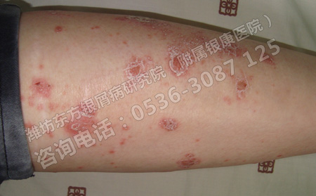 气温升高,银屑病患者不可以过度贪凉