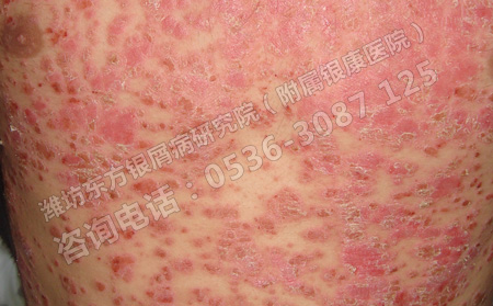 银屑病患者要如何提高自身抵抗力
