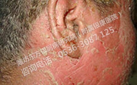 要怎样护理脸部的银屑病呢