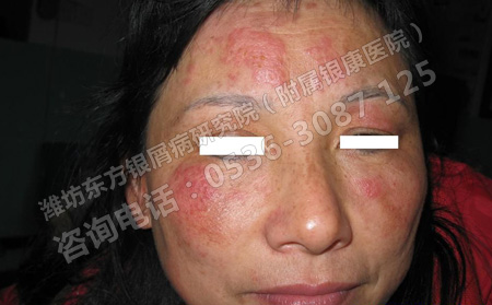 银屑病能不能有效治好呢