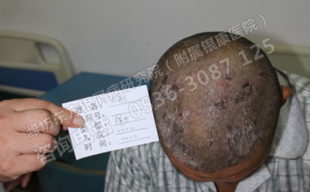 你了解头部银屑病发生的原因吗