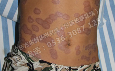 治疗儿童银屑病的重点在哪里