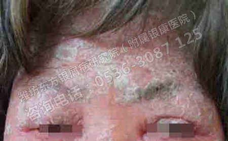 女性银屑病会影响生育吗