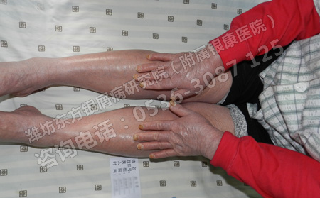 老年人身体虚弱得了银屑病怎么办呢