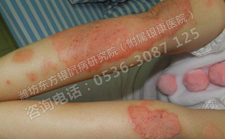 孩子得了银屑病家长要如何帮助他们护理