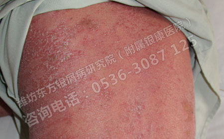 牛皮癣患者应该了解的三个错误观点
