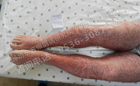 牛皮癣有什么症状