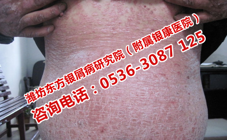 哪种方法治疗银屑病有效呢