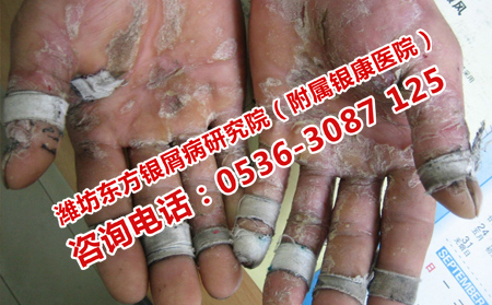 哪种方法治疗牛皮癣显著呢