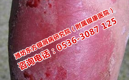 牛皮癣短期发作的原因是什么