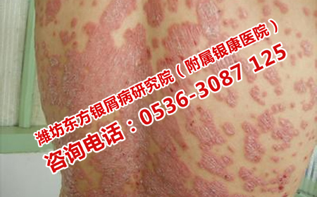 脓包型牛皮癣的皮肤护理方法
