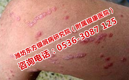 顽固牛皮癣应该怎么治疗呢