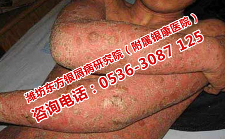 如何使局部牛皮癣不加重