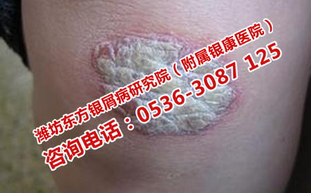 天气潮湿怎样预防牛皮癣加重