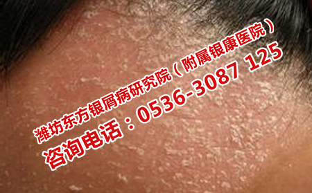 如何预防牛皮癣