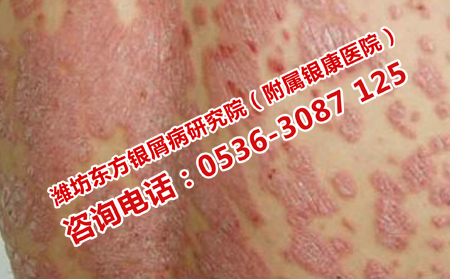 潍坊银康医院治治疗效果果