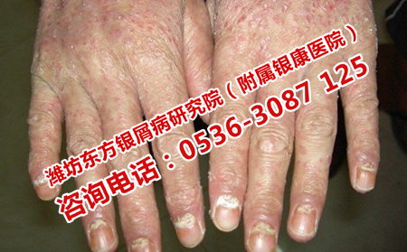 昌乐银屑病治疗费用