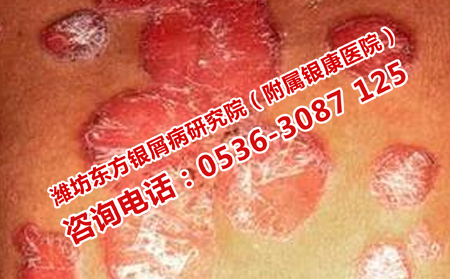 治疗银屑病的可以医院