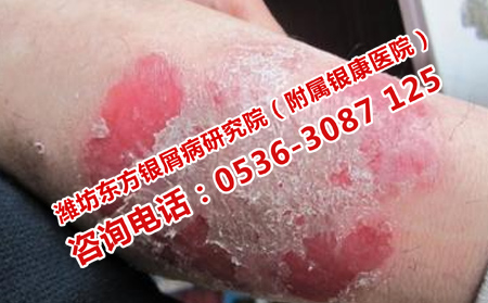哪里医院治银屑病可以
