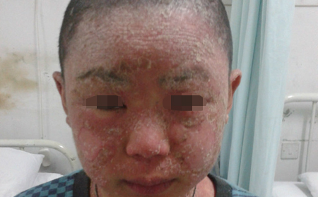 预防头部银屑病迁延加重的方法