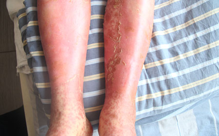 红皮型银屑病的症状