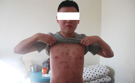 红皮型银屑病的危害