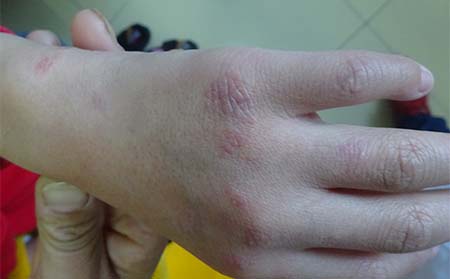 牛皮癣治疗