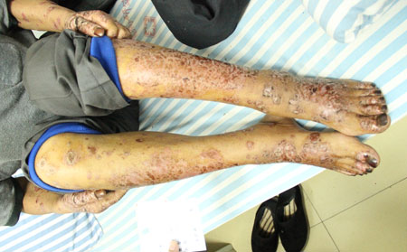 银屑病出现的原因有什么