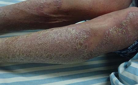 慢性关节型银屑病的原因